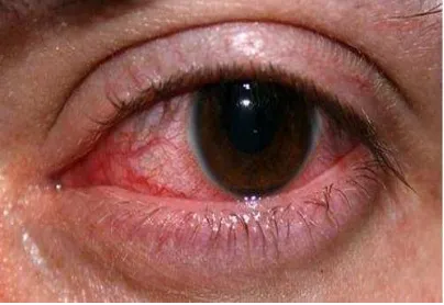 Gambar 1.1 Mata yang mengalami Konjungtivitis Akibat Virus 