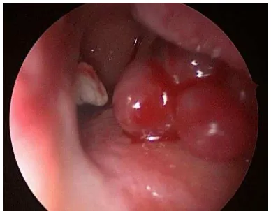Gambar 1. Gambaran naso-endoskopi hemangioma intranasal di kavum nasi sinistra (preoperatif)