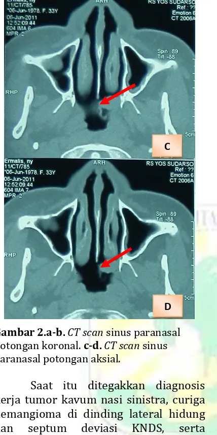 Gambar 2.a-b. CT scan sinus paranasal potongan koronal. c-d. CT scan sinus 