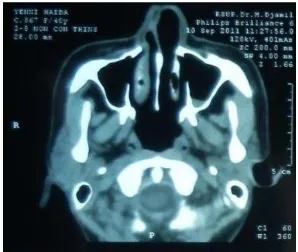 Gambar 1. Tomografi komputer sinus paranasal potongan aksial, tampak perselubungan pada sinus maksilaris sinistra  