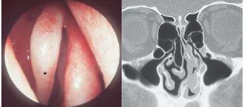 Gambar 3.  Double concha (PU paradoks). A. Temuan endoskopi B. Gambaran tomografi komputer 10  