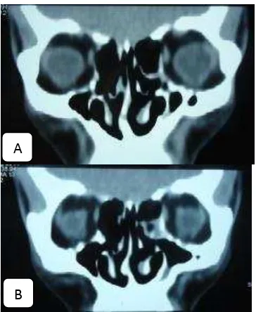 Gambar 6. Tomografi komputer sinus paranasal potongan  koronal. A. terlihat deviasi septum ke kanan