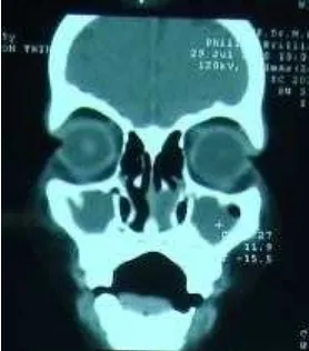Gambar 3 Tomografi komputer sinus paranasal (potongan coronal) 