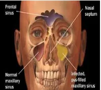 Gambar 1. Anatomi Sinus, dikutip dari kepustakaan 5 