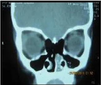 Figure 3. Haemangioma after extirpation 