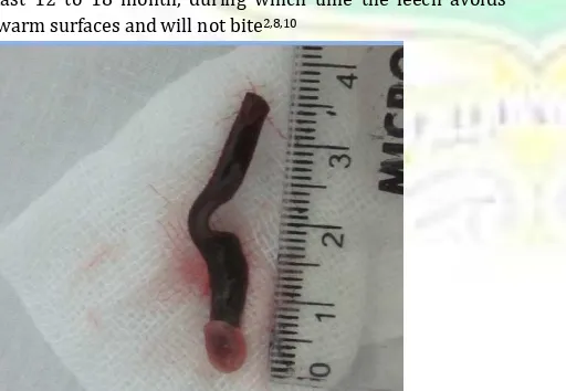 Figure 2. A leech taken from the nasal cavity of our patient 
