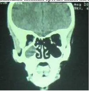 Gambar 4.  Tomografi komputer sinus paranasal (potongan koronal) 