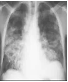 Gambar.2Gambaran radiologi pada pneumonia