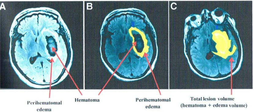 Gambar 2.3. Potongan axial dan gambaran MRI Brain yang menggunakan teknik FLAIR 