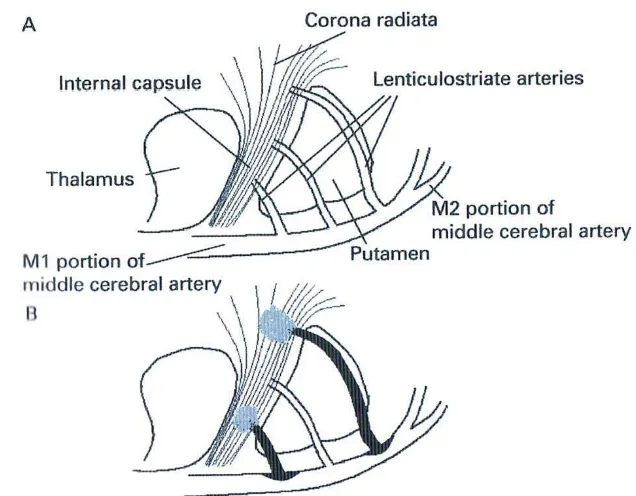 Gambar 2.4. Gambaran anatomis pembuluh darah basal ganglia. A) Lenticulo striata 