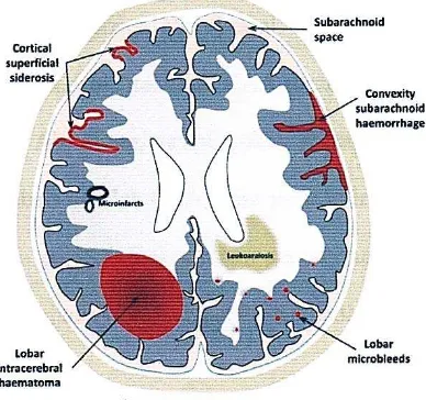 Gambar 2.5. Gambaran skematis manifestasi iskemik dan hemoragik yang diakibatkan oteh 