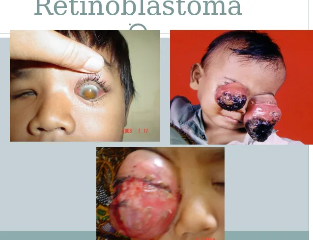 Gambar Retinoblastoma