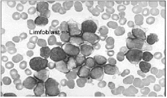 Gambar 2.1 Leukemia limfositik akut 