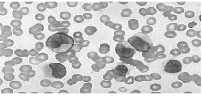 Gambar 2.2 Leukemia mielositik akut 