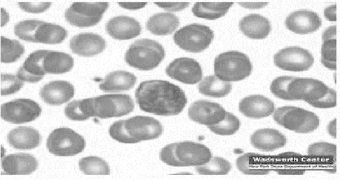 Gambar 2.3 Leukemia limfositik kronis 
