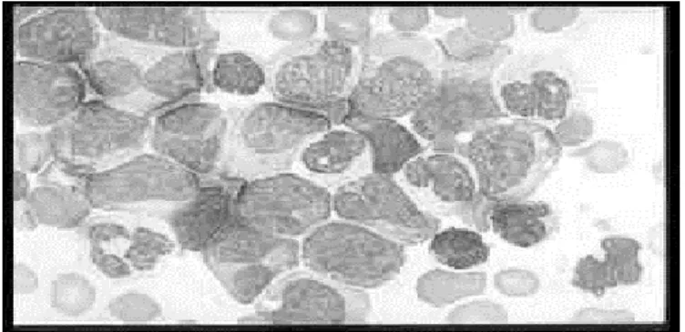 Gambar 2.4 Leukemia mielositik kronis 
