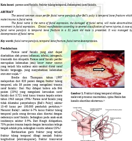 Gambar 1. Fraktur tulang temporal oblique melewati prosesus mastoideus, spina Henle dan kanalis akustikus eksternus.11 