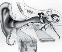Figure 1.  Coronal section of the ear canal. The skin of the cartilaginous and osseous canals are magnified  