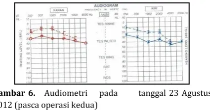 Gambar 6.   Audiometri    pada       tanggal 23 Agustus 