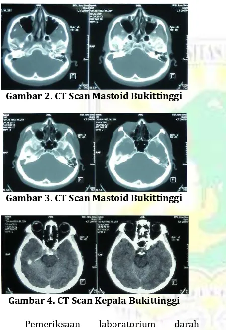 Gambar 2. CT Scan Mastoid Bukittinggi  