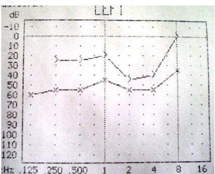 Gambar 3. Hasil audiometri telinga kiri setelah  operasi (20 Agustus 2010) 