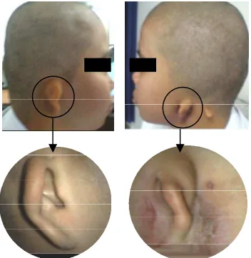 Gambar 1. Mikrotia Bilateral 