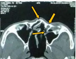 Gambar 3. Tomografi komputer sinus paranasal  potongan aksial 
