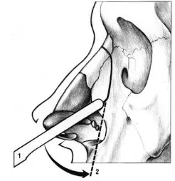 Gambar 8. Osteotomi lateral21 