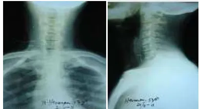 Gambar 2. Roentgen Foto servikal AP- lateral sebelum tindakan esofagoskopi di RS daerah