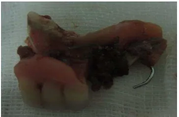 Gambar 5. Gigi palsu di esofagus 