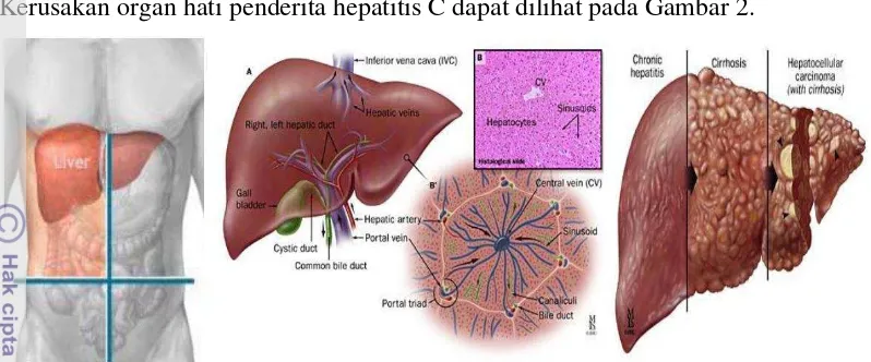 Gambar 2 Tahap perkembangan kerusakan hati pada penderita hepatitis C 