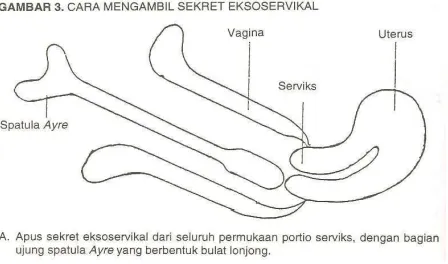 Gambar 2. Cara Mengambil Sekret Eksoservikal  