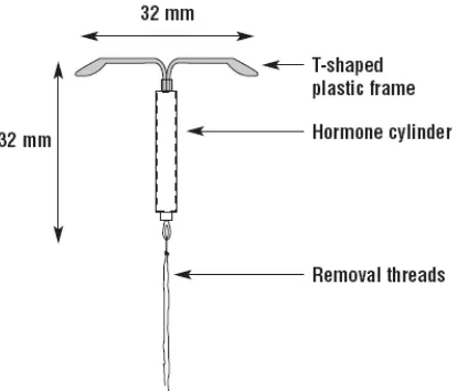 Gambar 2: Bagian-bagian IUD Copper-T 