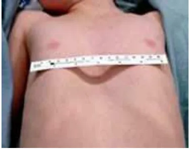Gambar 14. Flat chest 