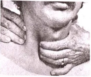 Gambar 1. Pemeriksaan palpasi Kelenjar tiroid 