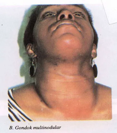 Gambar 3. Penonjolan Mata (eksoftalmus) pada hipertiroid (graves disease) 