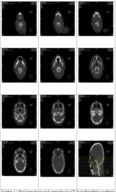 Gambar 4.1 Hasil pencitraan pada pemeriksaan CT-Scan Mandibula gambaran 