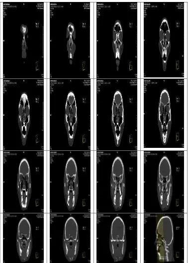 Gambar 4.2  Hasil pencitraan pada pemeriksaan CT-Scan Mandibula gambaran 