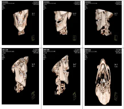 Gambar 4.3 Hasil pencitraan pada pemeriksaan CT-Scan mandibula setelah 