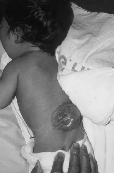Fig. 3.4 New-born infant with neural tube defect.