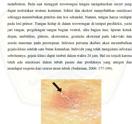 Gambar 2.2 Lesi Skabies Panah Hitam Menunjukan Adanya Tungau  