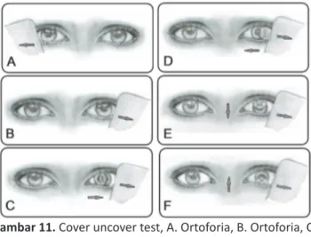 Gambar 11. Cover uncover test, A. Ortoforia, B. Ortoforia, C. 