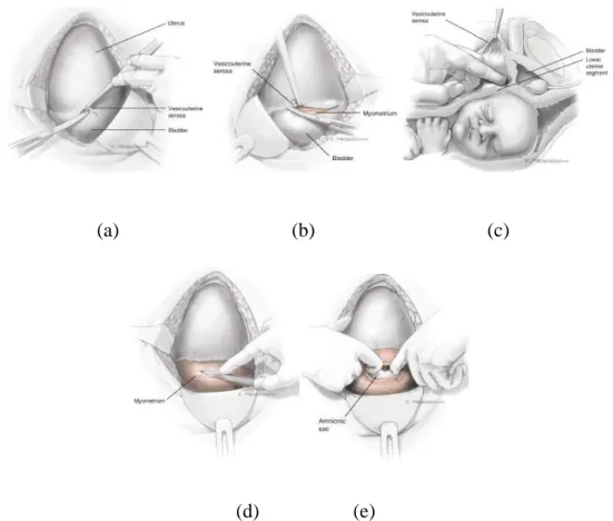 Gambar 2. 1. Lapisan insisi seksio sesarea (a) Peritoneum longgar di atas refleksi  kandung kemih digenggam dengan forsep lalu diiris dengan gunting Metzenbaum, 