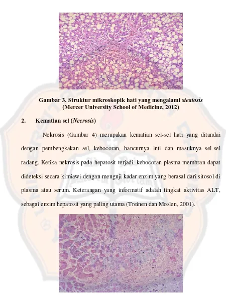 Gambar 3. Struktur mikroskopik hati yang mengalami  steatosis (Mercer University School of Medicine, 2012) 
