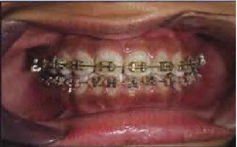 Gambar 2.1. Alat Ortodontik/Dental Braces (Kawat Gigi) 