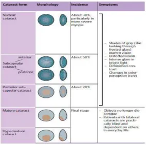 Gambar 2 : Intracapsular Cataract Extraction ( ICCE) 