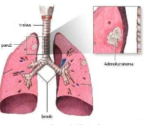 Gambar 2.1 Kanker Paru 