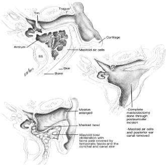Gambar 2.7. Radical mastoidectomy. SS, sigmoid sinus; Tm, tympanic 