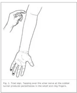 Figure 2. Percussion test (Tinel sign): Tapping 