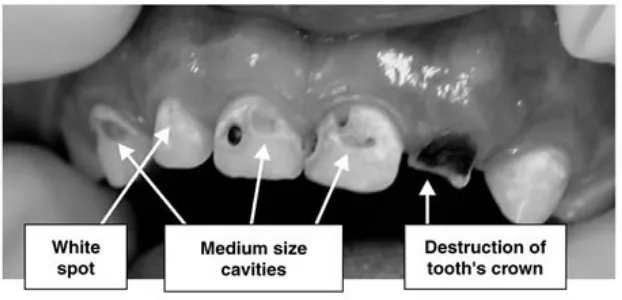 Gambar 3.   Gambaran klinis rongga mulut anak usia 4 tahun 